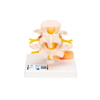 Lumbar vertebral discs with disc herniation